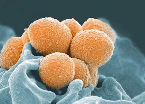 New addition to standard-of-care treatments for non-small-cell lung cancer patients has potential to increase progression-free survival